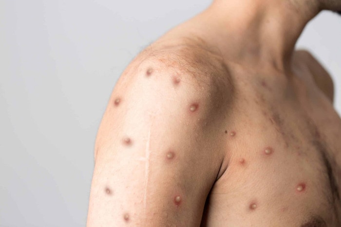 โรคฝีดาษลิง (Monkeypox) คืออะไร