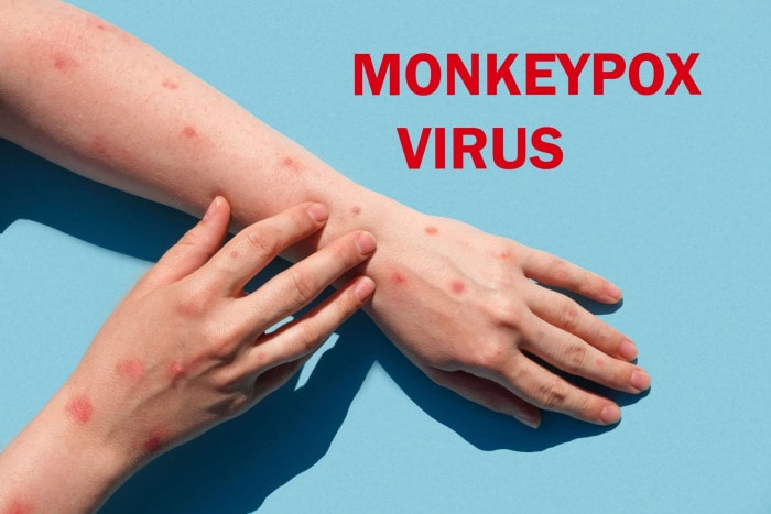 โรคฝีดาษลิง (Monkeypox) คืออะไร