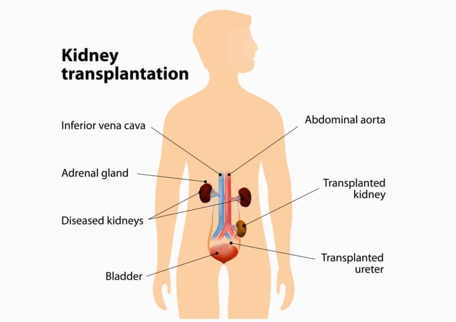 ทำไมต้องเปลี่ยนไตซ้ำ - โรงพยาบาลไทยนครินทร์